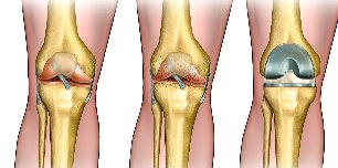 what is arthrosis