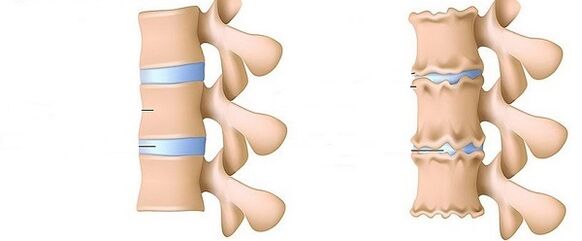 a healthy spine and osteochondrosis