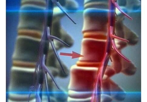 Squeezing of nerve endings in lumbar osteochondrosis