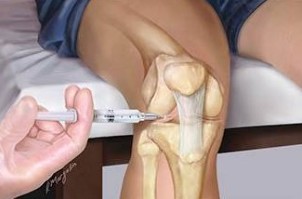 Injection with hyaluronic acid