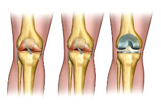 the degree of osteoarthritis