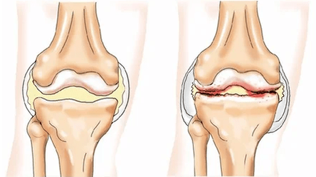 Chondromatosis