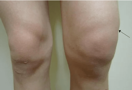 Hemarthrosis of the knee joint