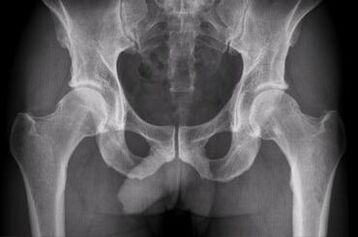 Diagnostic options for arthrosis of the hip joint