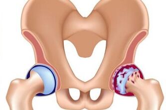 Stages of development of arthrosis of the hip joint