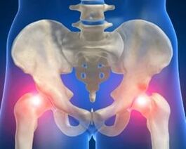 The causes of arthrosis of the hip joint