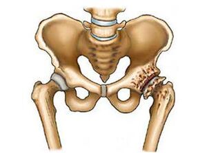 What is arthrosis of the hip joint